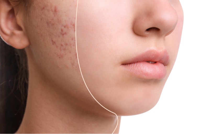 Acne Treatment: The Benefits of Herbal Remedies for Skin Health