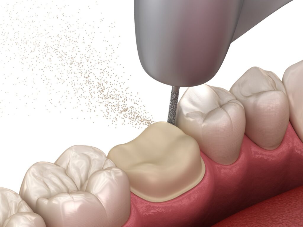 How Dental Crowns Preserve Tooth Structure